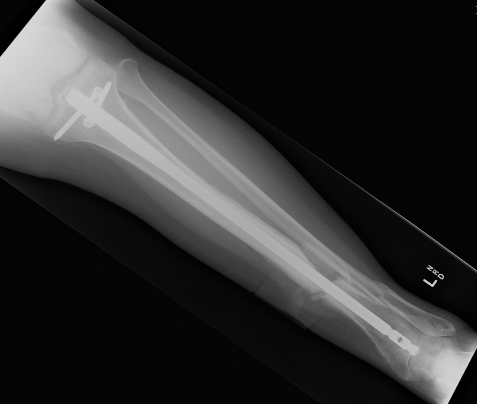 Infected Tibial Non Union Xray